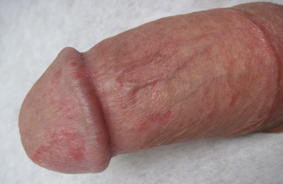 Balaniti Postiti e Balanopostiti